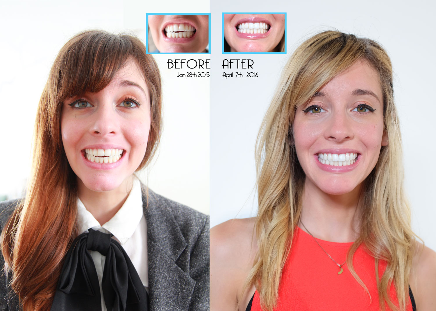 Invisalign