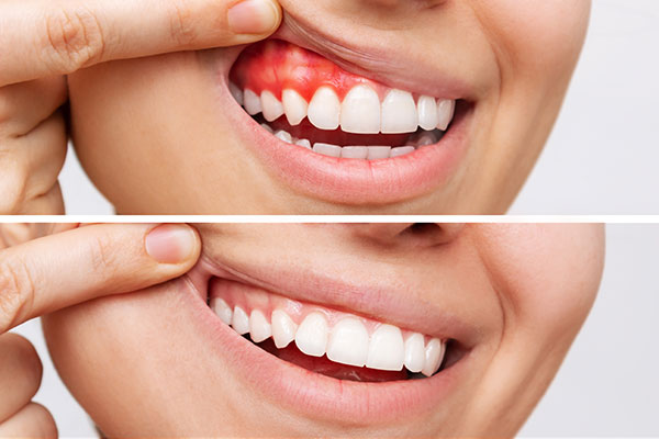 gum disease
