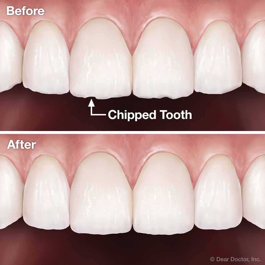 what is cosmetic tooth contouring and is it painful